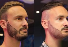 Beard Transplant in Istanbul 105 Beard Transplant in istanbul