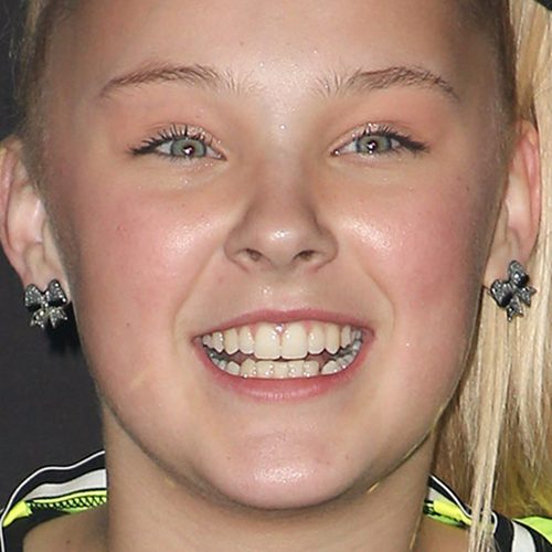 Jojo Siwa Veneers - Before & After | Turkey Health Magazin