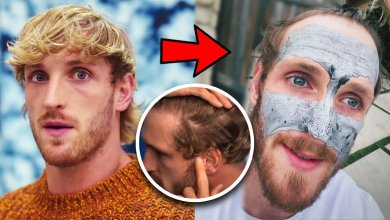 Logan Paul Hair Transplant - Before & After 100 logan paul hair transplant